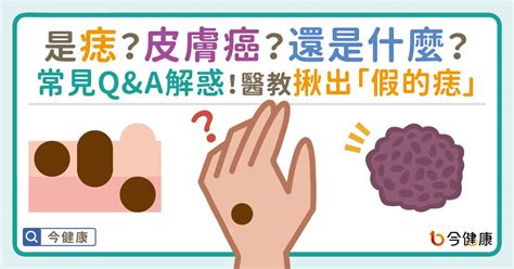 痣的顏色|是痣？皮膚癌？還是什麼？常見Q&A解惑！醫教揪出「。